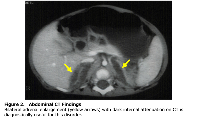 Figure 2.Abdominal CT Findings